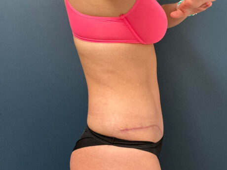 Tummy Tuck case #13918
