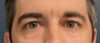 Eyelid Surgery case #13889