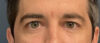 Eyelid Surgery case #13889
