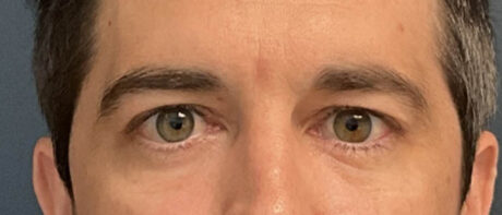 Eyelid Surgery case #13889