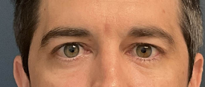 Eyelid Surgery case #13889
