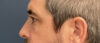 Eyelid Surgery case #13889