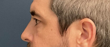 Eyelid Surgery case #13889