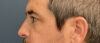 Eyelid Surgery case #13889