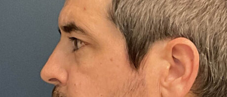 Eyelid Surgery case #13889
