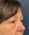 Eyelid Surgery case #13901