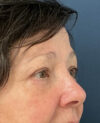 Eyelid Surgery case #13901