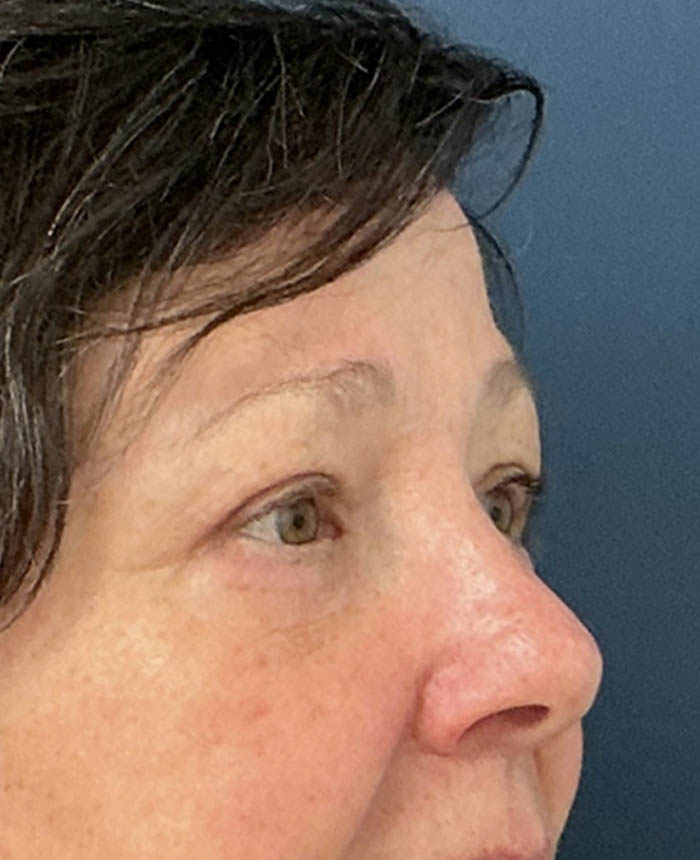 Eyelid Surgery case #13901