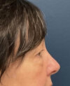 Eyelid Surgery case #13901
