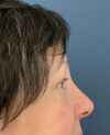 Eyelid Surgery case #13901