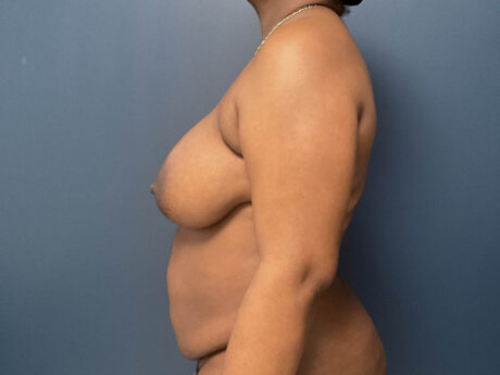 Tummy Tuck case #13978