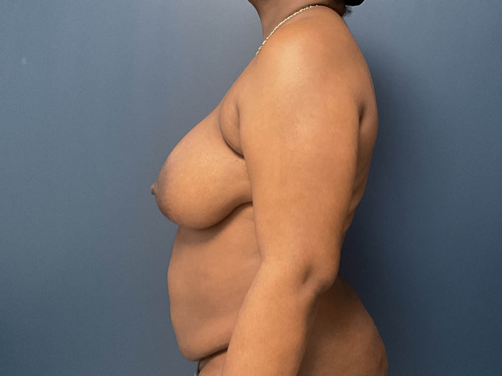Tummy Tuck case #13978