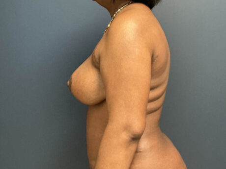 Tummy Tuck case #13978