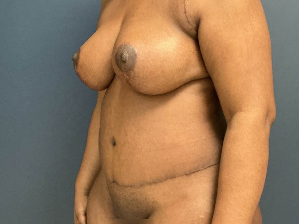 Tummy Tuck case #13978
