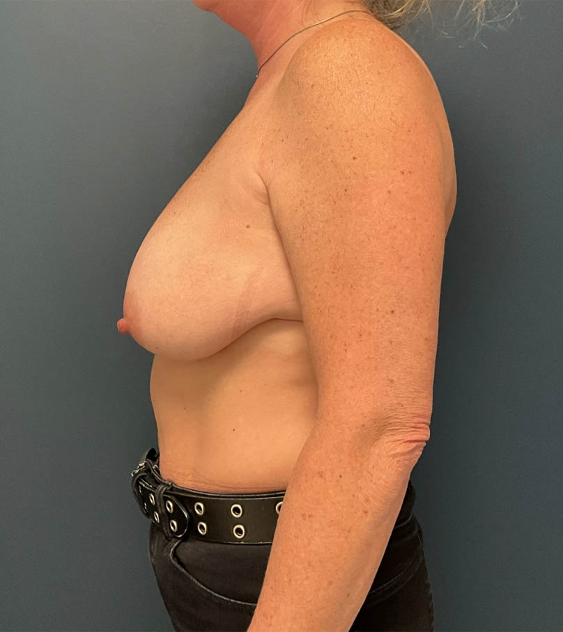 Breast Augmentation case #14733