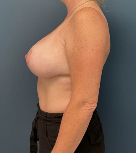 Breast Augmentation case #14733