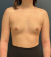 Breast Augmentation case #14747