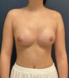 Breast Augmentation case #14747