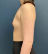 Breast Augmentation case #14747