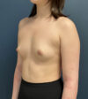 Breast Augmentation case #14747