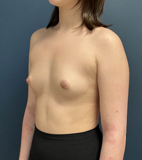 Breast Augmentation case #14747