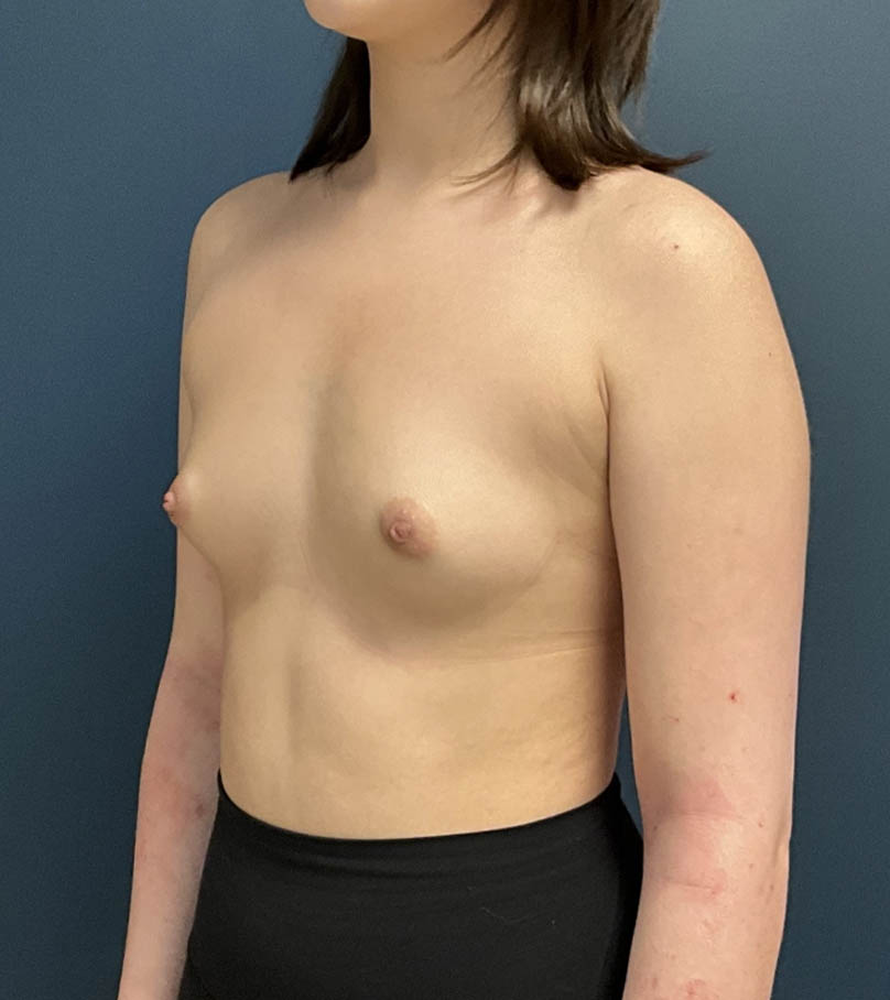 Breast Augmentation case #14747