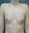 Breast Augmentation case #14761