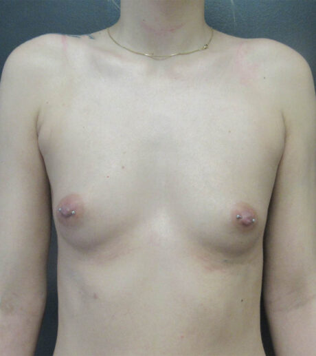 Breast Augmentation case #14761