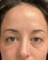 Eyelid Surgery case #14717
