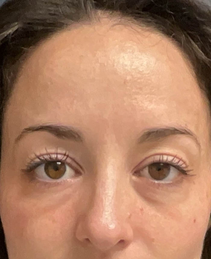 Eyelid Surgery case #14717