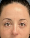 Eyelid Surgery case #14717