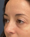 Eyelid Surgery case #14717