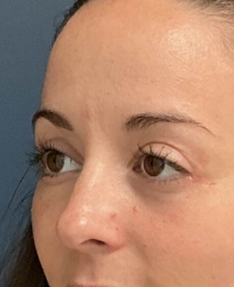 Eyelid Surgery case #14717
