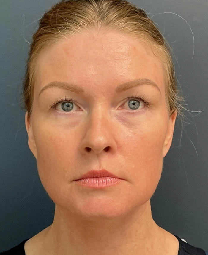 Neck Lift case #14726