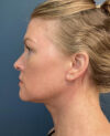 Neck Lift case #14726
