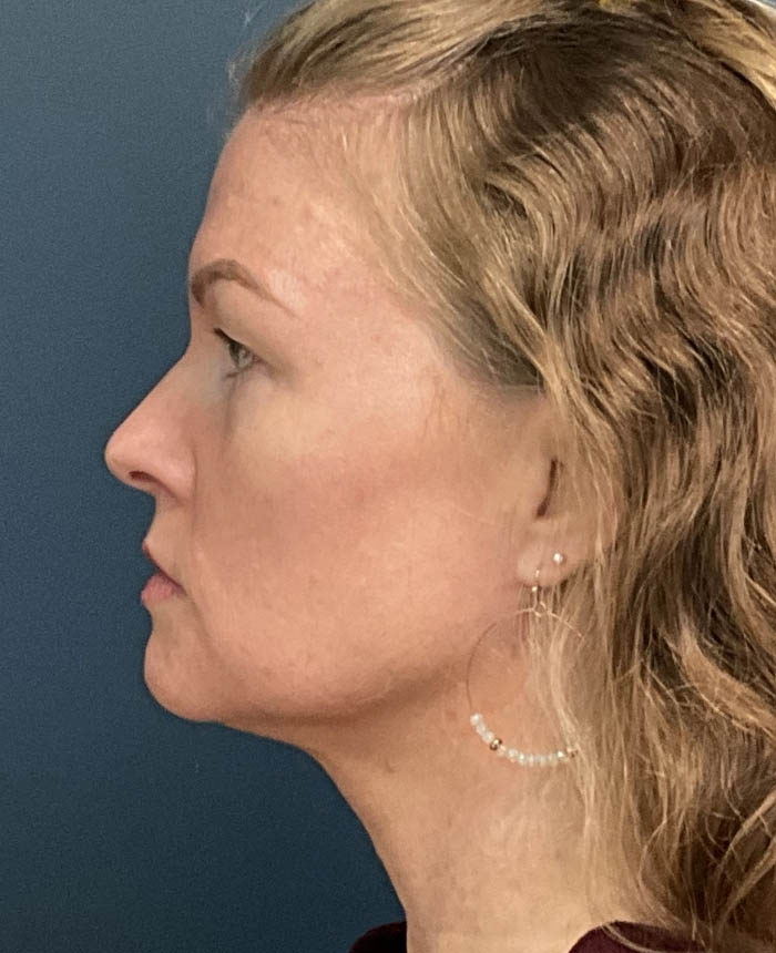 Neck Lift case #14726