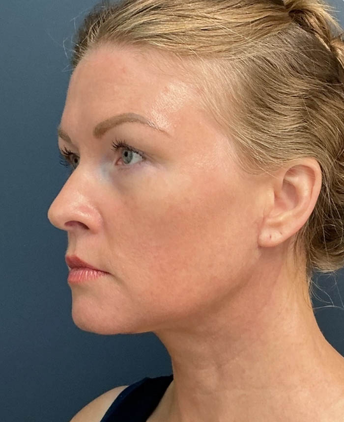 Neck Lift case #14726