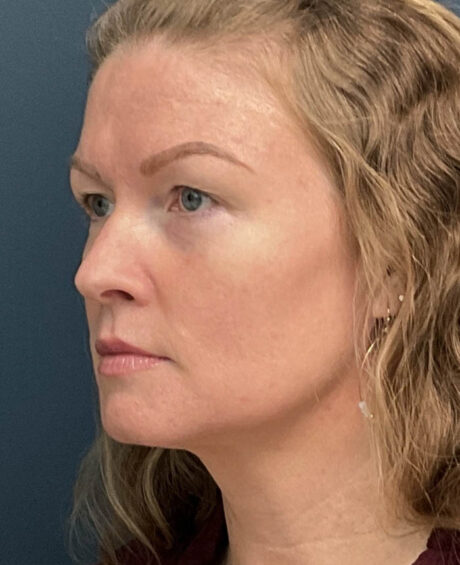 Neck Lift case #14726
