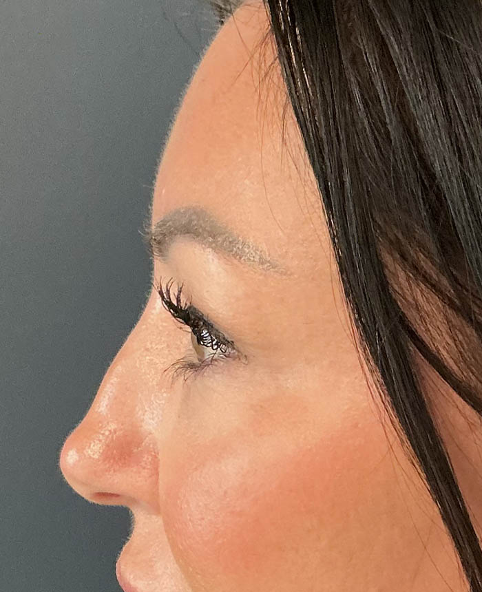 Eyelid Surgery case #15007