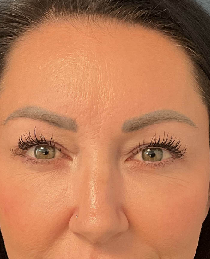 Eyelid Surgery case #15007