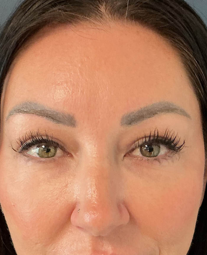 Eyelid Surgery case #15007