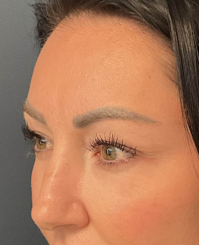 Eyelid Surgery case #15007