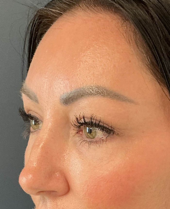 Eyelid Surgery case #15007