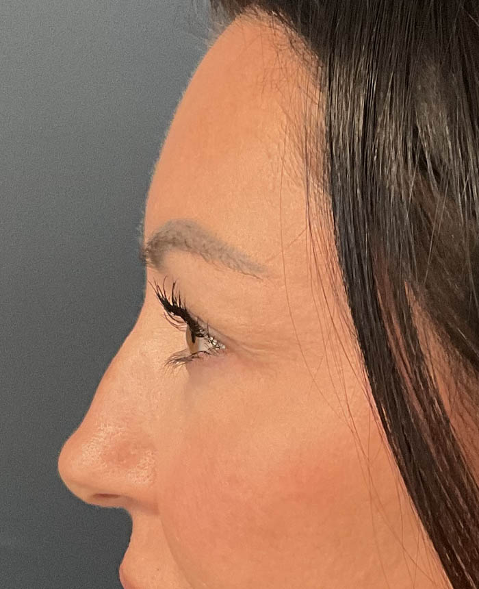 Eyelid Surgery case #15007