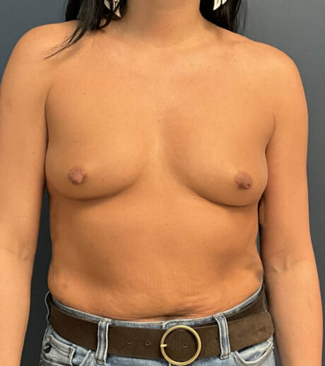 Breast Augmentation case #15423