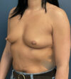Breast Augmentation case #15423