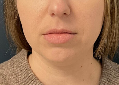 Chin Liposuction case #15438