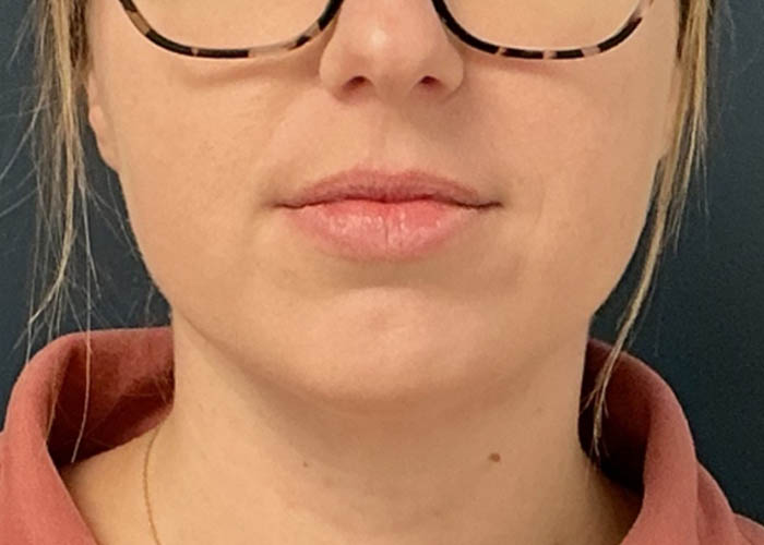 Chin Liposuction case #15438