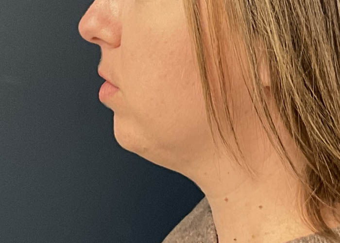 Chin Liposuction case #15438