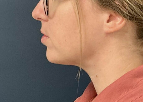 Chin Liposuction case #15438